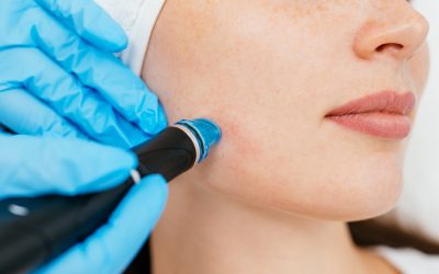 Razlike između profesionalnog tretmana i kućnih uređaja za microneedling